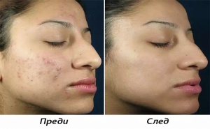 Повърхностен химичен пилинг за чиста и сияйна кожа от SunClinic, София
